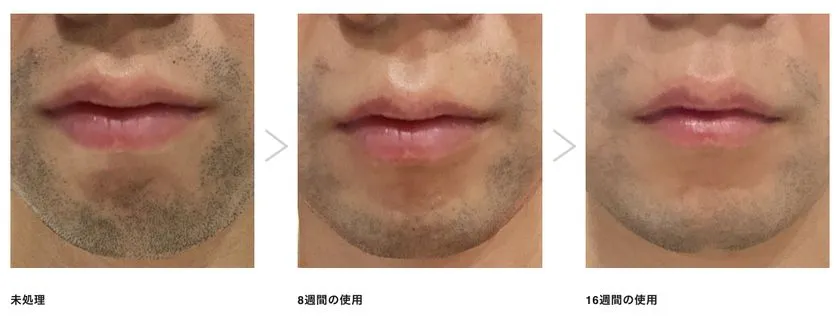 男性のヒゲへの使用ビフォーアフター比較