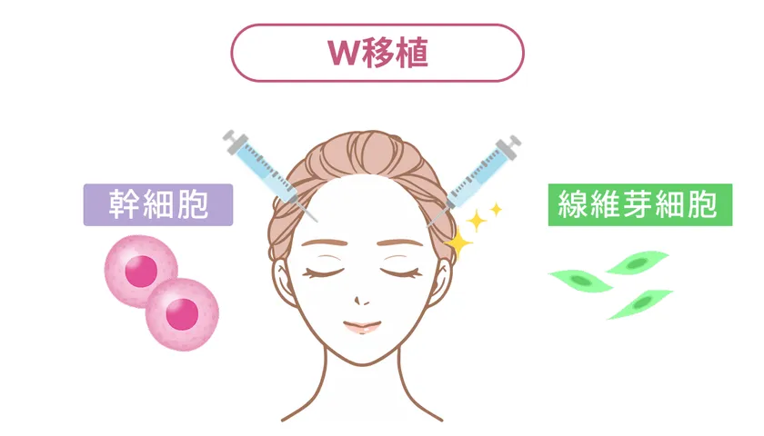 W移植治療の仕組みを説明したイラスト図解。女性の顔に左右から注射器を当て、幹細胞と線維芽細胞を同時注入することを視覚化した施術概念図